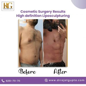 Liposuction surgery