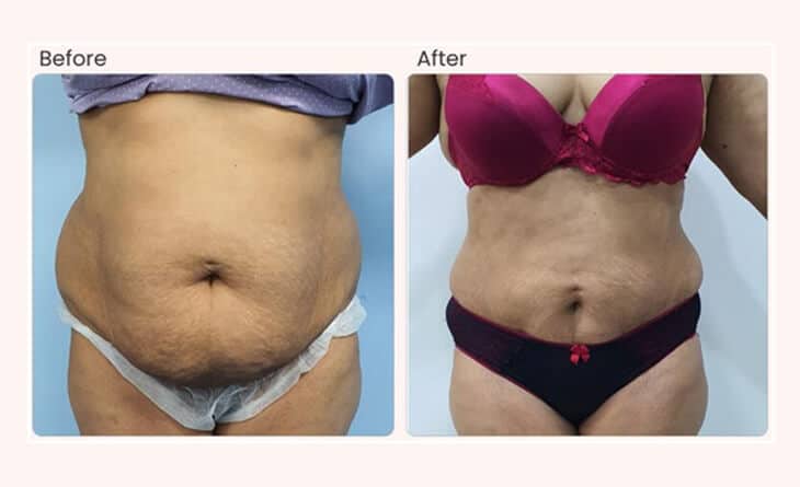 Liposuction surgery