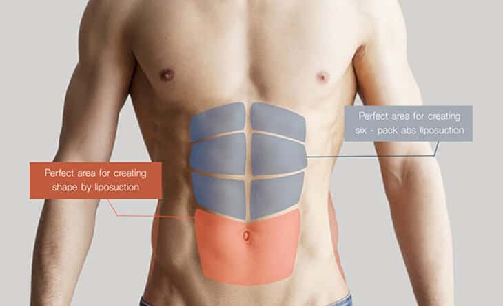 6 Pack Abs surgery