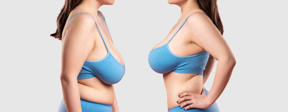 Breast Reduction Surgery in India