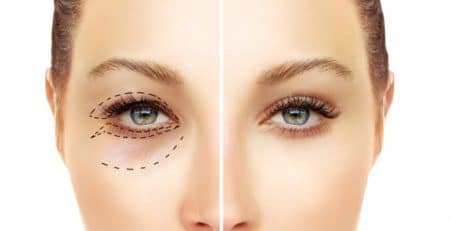 Blepharoplasty Surgery