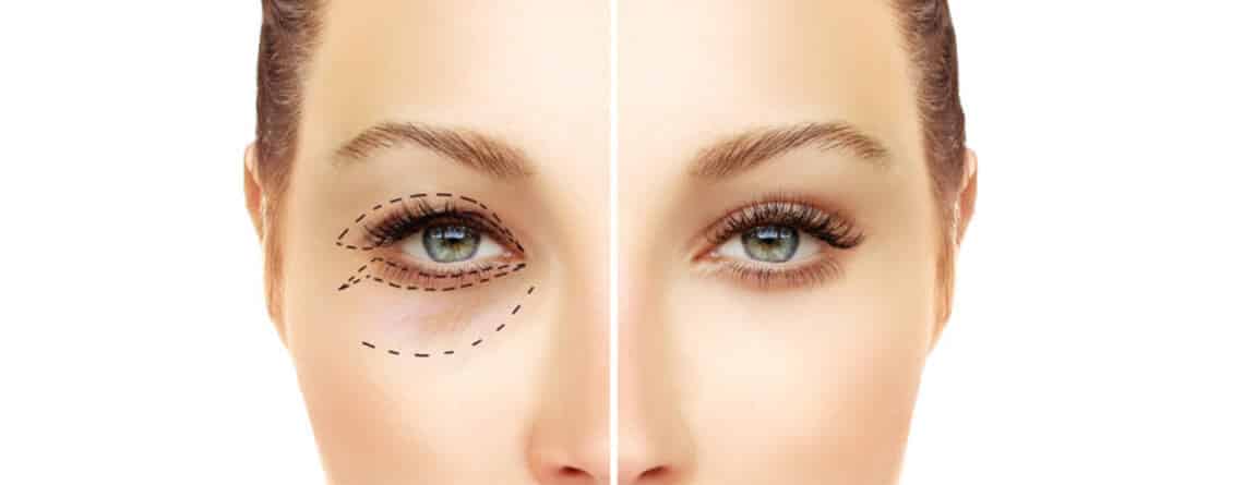 Blepharoplasty Surgery