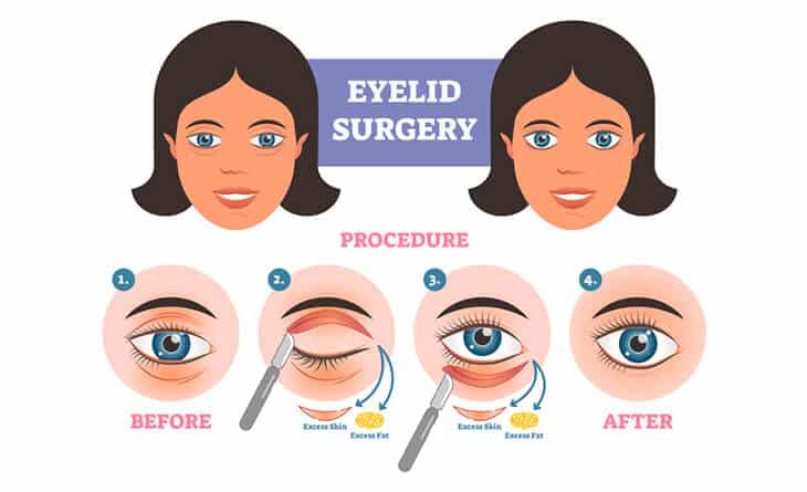 Upper Eyelids Blepharoplasty