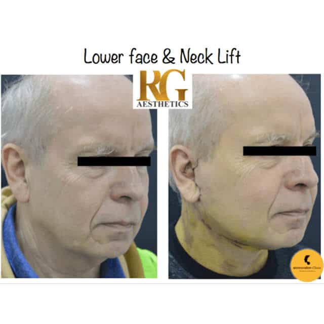 blepharoplasty