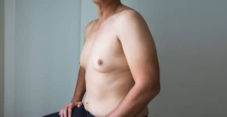Male Breast Reduction Surgery