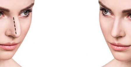 Rhinoplasty Surgery in India
