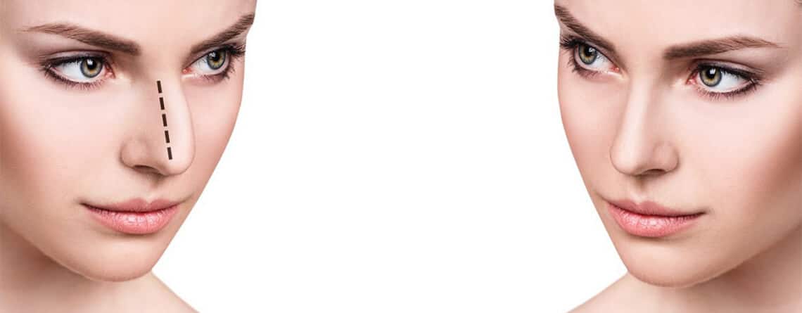 Rhinoplasty Surgery in India
