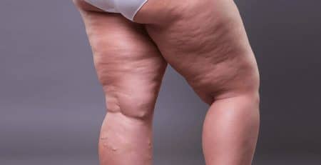 Liposuction for Cellulite