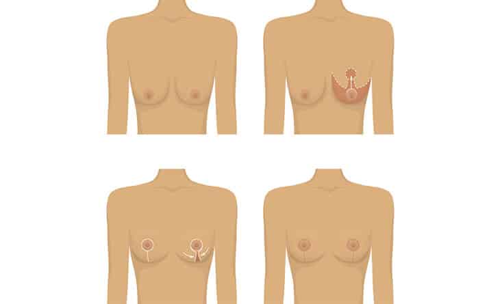 Breast Lift Surgery