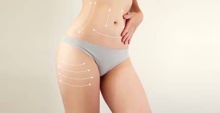 Liposuction Procedure