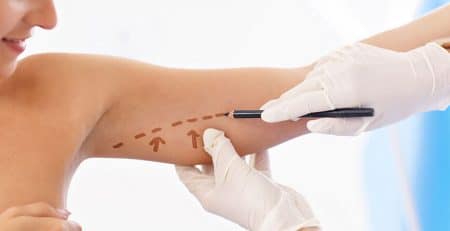 Arm Lift Procedure
