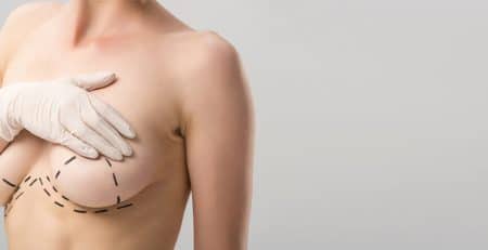 Breast Lift Procedure