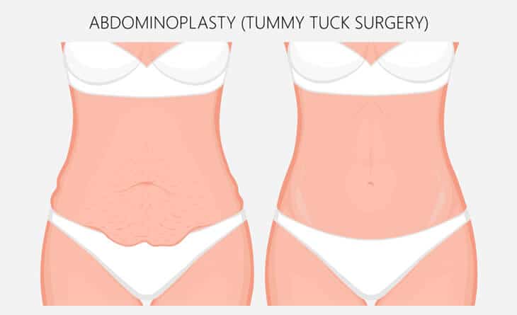 Tummy Tuck Procedure