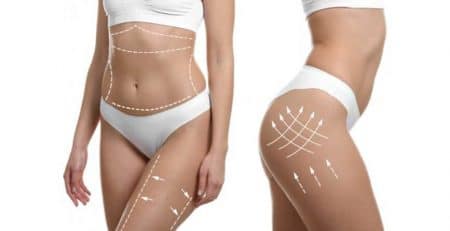 Liposuction treatment in Delhi