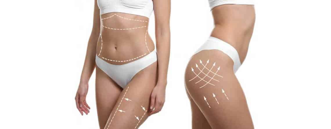 Liposuction treatment in Delhi