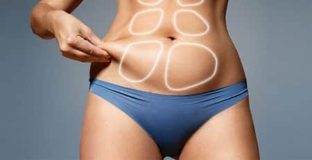 Liposuction procedure