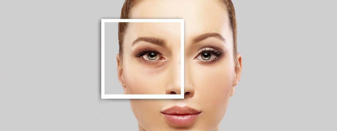 Blepharoplasty Surgery Procedure