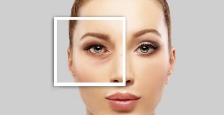 Blepharoplasty Surgery Procedure