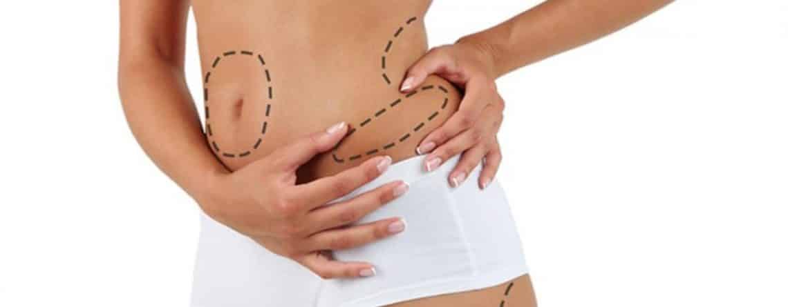 Liposuction procedure