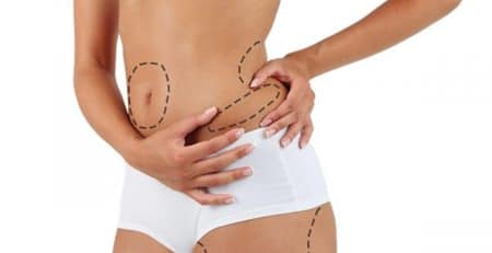 Liposuction procedure