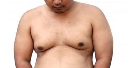 Gynecomastia Surgery in Delhi