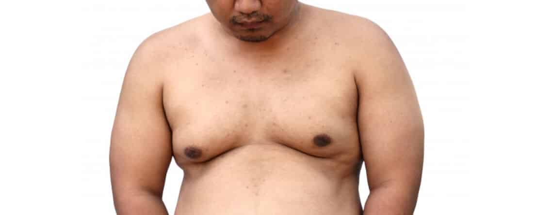 Gynecomastia Surgery in Delhi