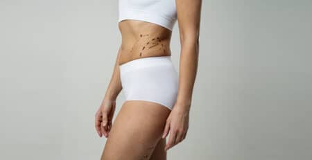 Liposuction procedure