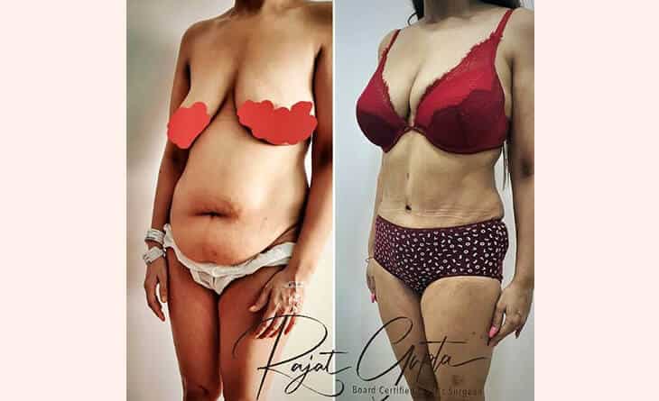 Liposuction Surgery Before After Results - Liposuction Procedure
