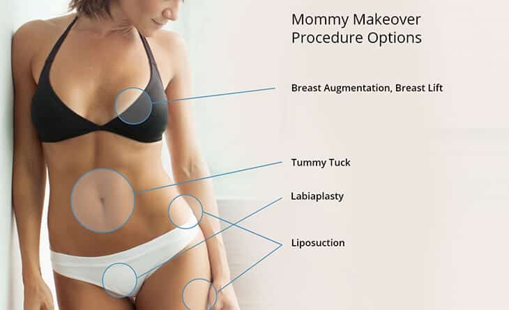Tummy tuck procedure