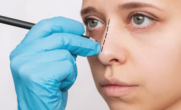 rhinoplasty procedure