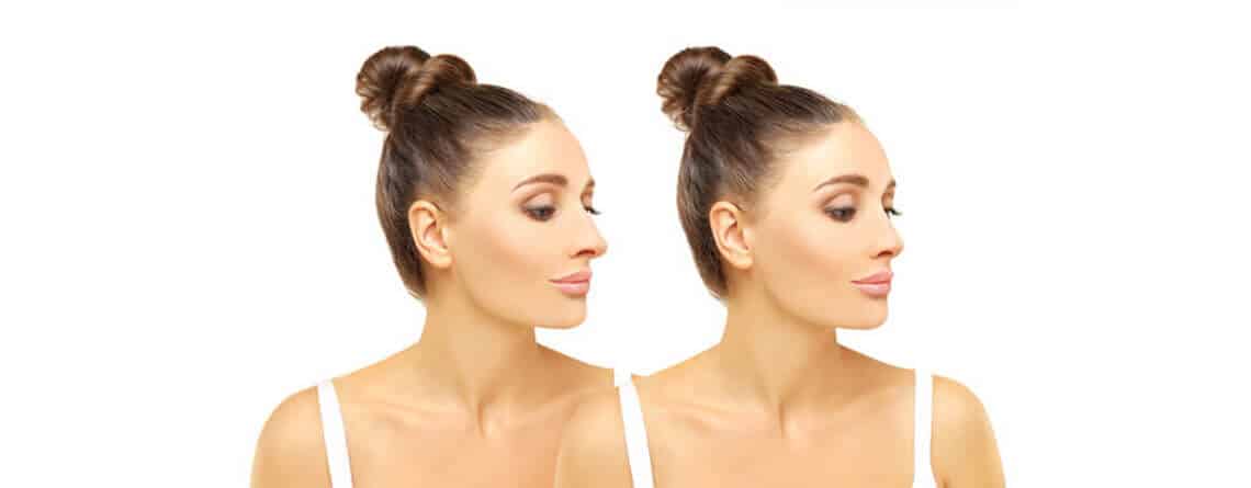 rhinoplasty procedure