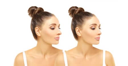 rhinoplasty procedure