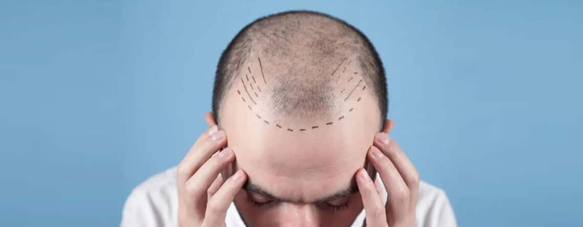 Hair Transplant in Delhi