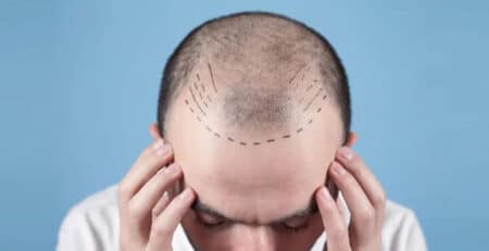Hair Transplant in Delhi