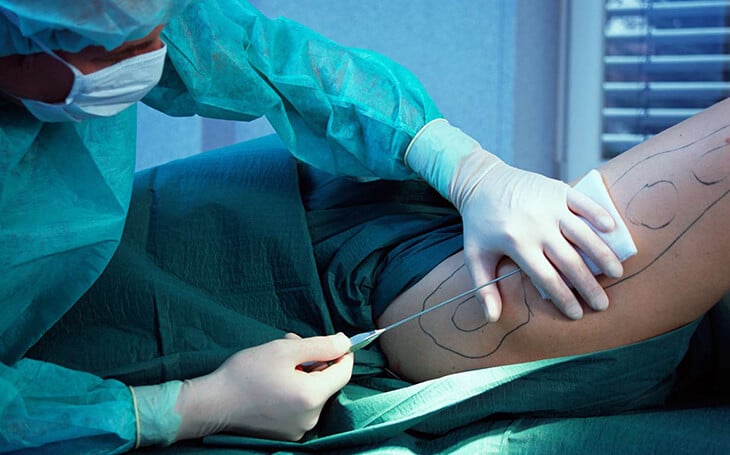 Liposuction procedure