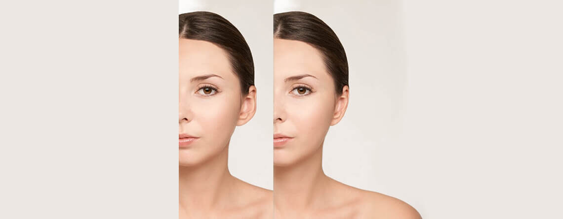 Otoplasty Surgery in Delhi