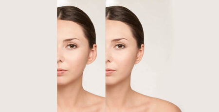 Otoplasty Surgery in Delhi