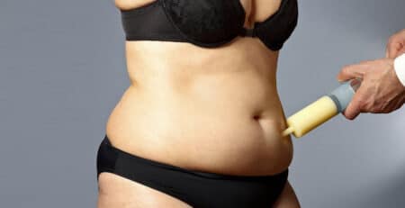 Fat Removal Surgery