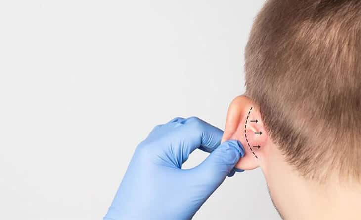 Otoplasty Surgery