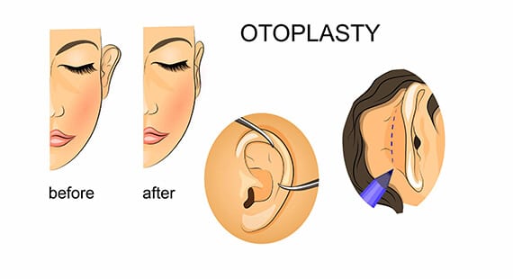 Otoplasty Surgery