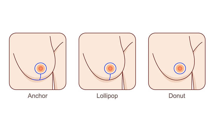 Breast Lift Options