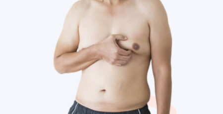 gynecomastia procedure in Delhi