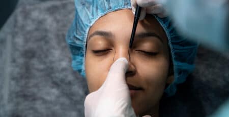 Rhinoplasty Procedure in Delhi
