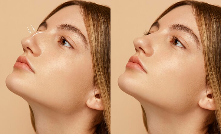 Rhinoplasty Procedure in Delhi