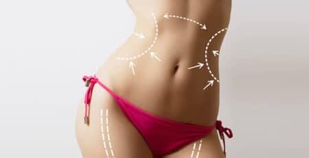 Liposuction procedure in Delhi