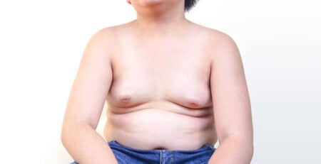 teenage gynecomastia