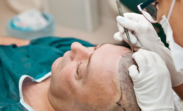 Hair Transplant in Delhi