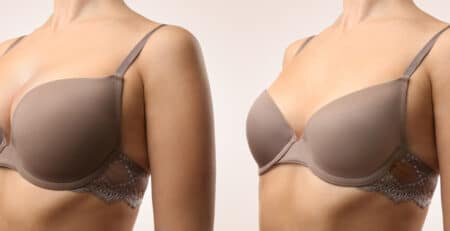 breast augmentation surgery in Delhi