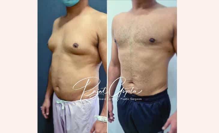 gynecomastia Surgery