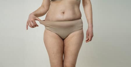 Abdominoplasty surgery